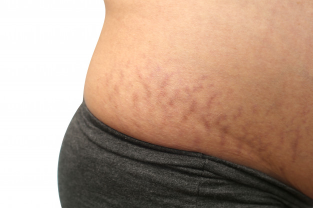 Stretch marks around pregnant woman's belly